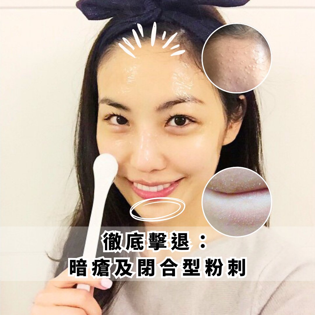 徹底擊退：比暗瘡更難纏的閉合型粉刺 - éPure