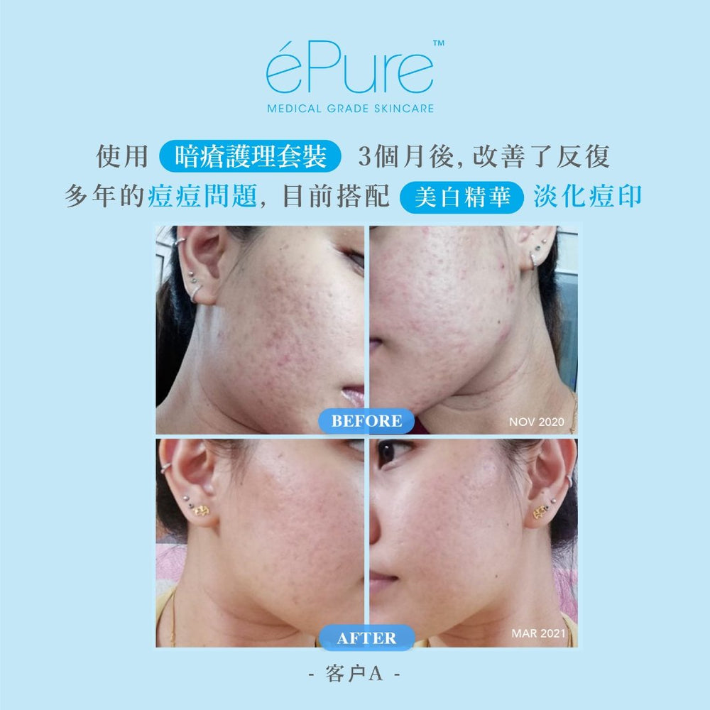 
                  
                    20% 杏仁酸煥膚亮白精華 - éPure
                  
                